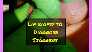 Lip Biopsy to Help Diagnose Sjögrens Disease [upl. by Ahsea]