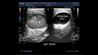 Ultrasound Video showing a mass in testis with torsion and an epididymal cyst [upl. by Nnoryt]