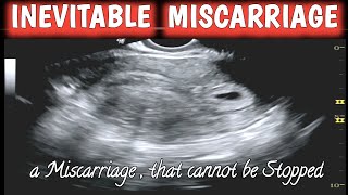 Inevitable Miscarriage  Early Pregnancy Missed Abortion [upl. by Dinny]