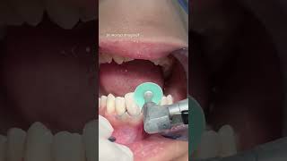 Dental composite veneer satisfying [upl. by Cleodel]