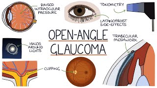 Understanding Open Angle Glaucoma [upl. by Akiemaj]