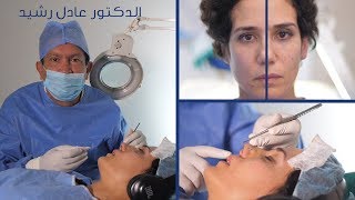 Rhinoplastie  une chirurgie impressionnante docteur aadil rachid [upl. by Olivier]