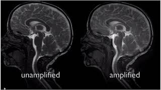 Types of Chiari Malformation [upl. by Nelleh]