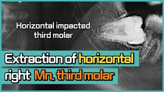 Wisdom teeth removalHorizontal impacted Rt Mn Third molar by OMFS surgeon DrOh [upl. by Bradstreet]