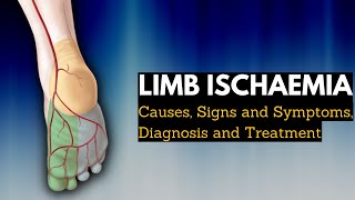 Limb Ischaemia  Causes Signs and Symptoms Diagnosis and Treatment [upl. by Eillen]