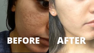 MY CO2 LASER RESURFACING TREATMENT EXPERIENCE  how to get rid of acne scars amp hyperpigmentation [upl. by Auguste]