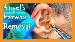 Angels Earwax Removal  Auburn Medical Group [upl. by Yroffej117]