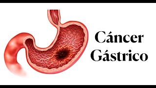 Cáncer Gástrico  Síntomas Diagnóstico y Prevención  Cáncer de estómago [upl. by Punak443]