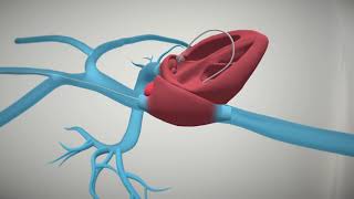 ProtekDuo® Cannula Support Animation [upl. by Arramahs]