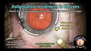 CataractCoach™1716 astigmatism treatment in RK eyes  radial keratotomy [upl. by Wickner]