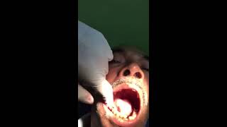 Extraction of lower right first molar [upl. by Saunder]