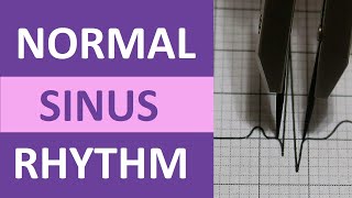 Normal Sinus Rhythm Nursing Made Easy on ECGEKG Heart Interpretation [upl. by Tonya]