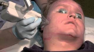 Fraxel Laser Subcision Acne Scar Treatment [upl. by Notna]