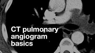 Pulmonary CT Angiogram Basics [upl. by Jacquet414]