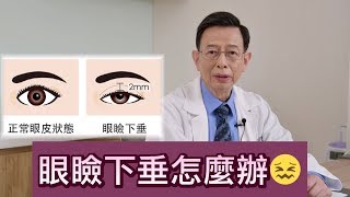 眼瞼下垂怎麼辦？【晶華美醫診所】徐典雄醫師｜台北眼瞼下垂手術 眼瞼下垂手術推薦 眼瞼下垂治療改善 [upl. by Aisayt998]