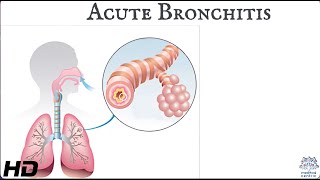 Acute bronchitis Everything You Need To Know [upl. by Mingche]