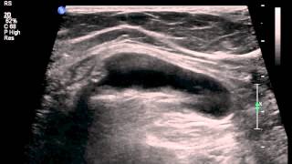 spigelian hernia reduction ultrasound [upl. by Vinia]