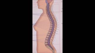 Disability from Spinal Stenosis and Arthritis [upl. by Christianson]