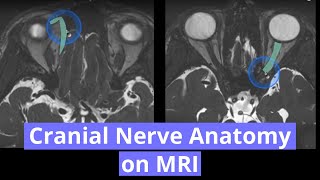 Cranial Nerve Anatomy on MRI [upl. by Suoicul]