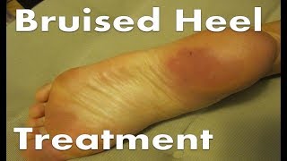 Bruised Heel Pain Treatment BEST Home Remedies 2020 [upl. by Berglund]