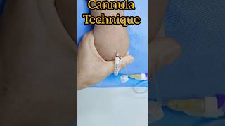 How to insert cannula  cannula passing technique trending shorts viralshorts [upl. by Berget]