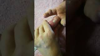 Gout on middle finger [upl. by Riggins]