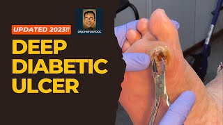 How to Cure Deep Diabetic Ulcers Fast [upl. by Audette]