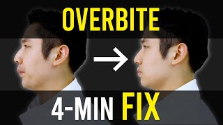 Overbite amp Overjet Fix｜Facial Asymmetry Correction｜Corrective Exercises [upl. by Ventura742]