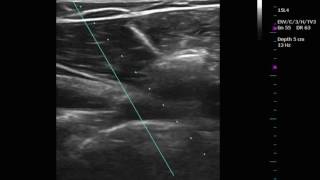 Ultrasound guided posterior glenohumeral joint injection [upl. by Wilhelm149]