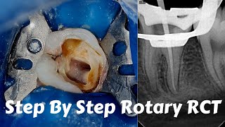 Live Steps Root Canal Rotary Protaper Endodontic Procedure ACP BMP obturation irrigation [upl. by Bray]