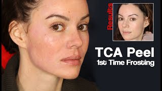 TCA Chemical Peel at Home  Demo Updates Results 20 [upl. by Salamanca]