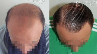 FUT Haartransplantation 3170 FU´s  Norwood 6 [upl. by Nelehyram853]