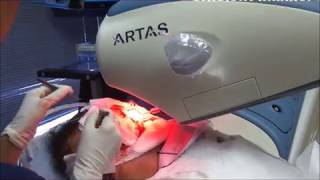 ARTAS Robot Assisted FUE Hair Transplant at Limmer Hair Transplant Center [upl. by Gyasi924]