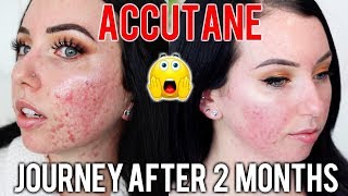 MY ACCUTANE JOURNEY 2 MONTH UPDATE Before amp After Side Effects Skin Care Products Im using [upl. by Sumedocin]