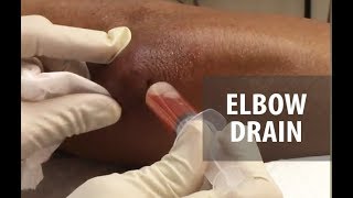 Elbow Drainage  Elbow Olecranon Bursitis  Dr Derm [upl. by Rabiah]