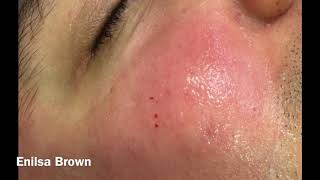 Christians Acne Treatment  Blackheads Extractions [upl. by Prudi195]