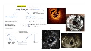 DES instent restenosis mechanisms and interventional management Elias Hanna [upl. by Standley]