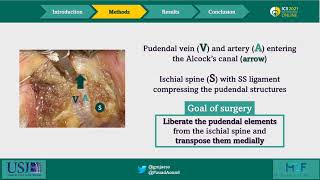 22832 Laparoscopic transperitoneal pudendal nerve and artery release for pudendal entrapment sy [upl. by Pier]