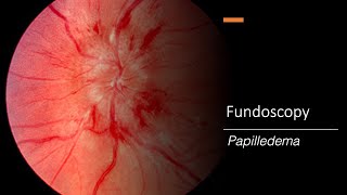 Papilledema Fundoscopy [upl. by Ynaffets463]