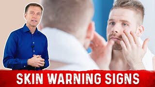 7 Skin Warning Signs of Diabetes [upl. by Mharba229]