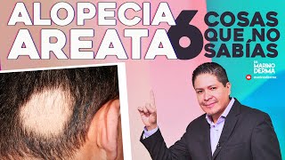 ALOPECIA AREATA 6 COSAS QUE NO SABIAS [upl. by Eybba706]