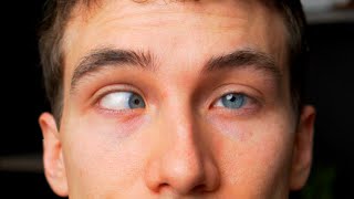 CROSS EYED What is Strabismus  Types Causes Treatments Eye Doctor Explains [upl. by Malvia630]