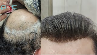 9899746489 Natural Hair Patch Service in Delhi  Amazing Frontline Hair Patch [upl. by Fraser]