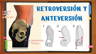 ✅RETROVERSIÓN Y ANTEVERSIÓN PÉLVICA ¿Qué es fácil [upl. by Idola]