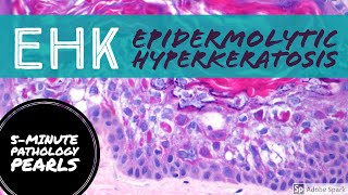 Epidermolytic Hyperkeratosis EHK 5Minute Pathology Pearls [upl. by Nellahs]