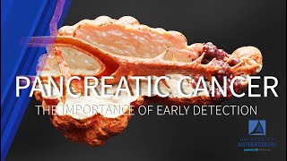 Pancreatic Cancer The Importance of Early Detection [upl. by Kathie809]