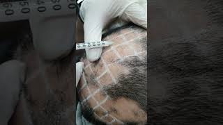 Demo19 Intralesional triamcinolone for alopecia areata [upl. by Mahalia]