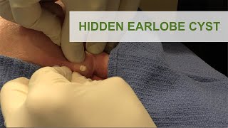 Hidden Earlobe Cyst  Dr Derm [upl. by Yazbak]