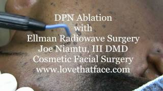 DPN Removal With Ellman Radiowave Surgery by Dr Joe Niamtu [upl. by Ecinhoj101]