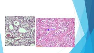 Invasive cribriform carcinoma [upl. by Ledeen]